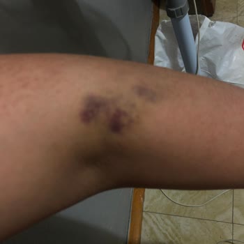 Bursa Çekirge Devlet Hastanesi Acil Müşahede Kolumu Mahvettiler