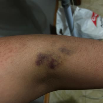 Bursa Çekirge Devlet Hastanesi Acil Müşahede Kolumu Mahvettiler