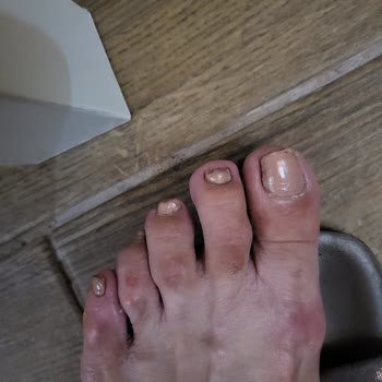 Skechers Ayakkabı Ayaklarıma Zarar Verdi.