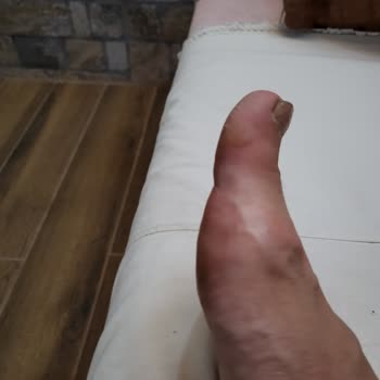 Skechers Ayakkabı Ayaklarıma Zarar Verdi.