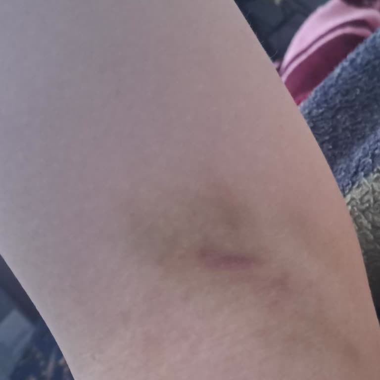 Davraz Yaşam Hastanesi Hemşire Kanımı Alırken Kolumu Mahvetti