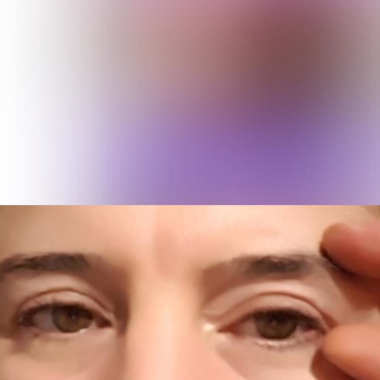 Çekmeköy Devlet Hastanesi Başarısız Üst Göz Kapağı Ameliyatı