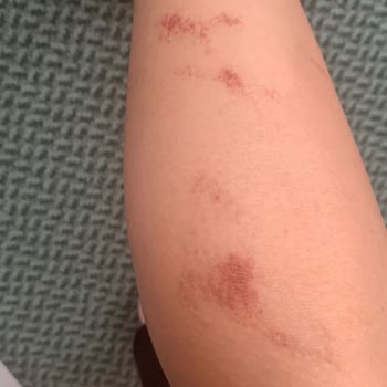 Zendora Deluxe Epilasyon Hizmetinde Yaşanan Sorunlar Ve Müşteri Memnuniyetsizliği