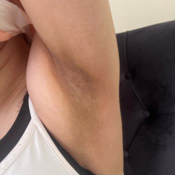 Nivea Deodorant Sonrası Tenimde Kararma Oldu