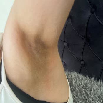 Nivea Deodorant Sonrası Tenimde Kararma Oldu