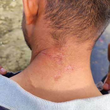 Orva İlaç Sanayi Lazer Epilasyon Sonrası Kalan İzler Korkutuyor