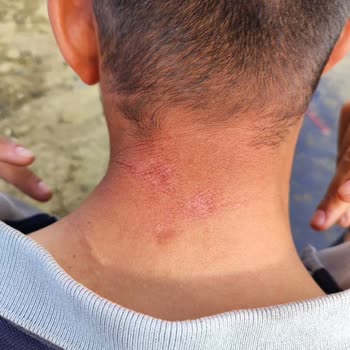 Orva İlaç Sanayi Lazer Epilasyon Sonrası Kalan İzler Korkutuyor