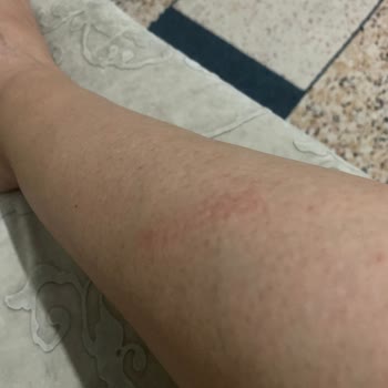 Dilek Elbir Beauty Center Lazer Epilasyon Deneyimim