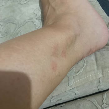 Dilek Elbir Beauty Center Lazer Epilasyon Deneyimim