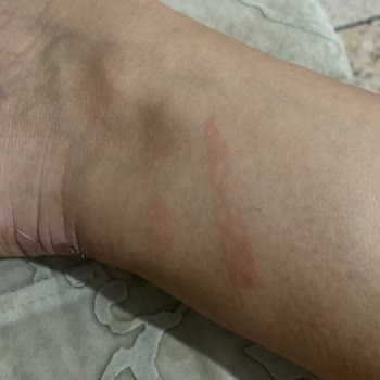 Dilek Elbir Beauty Center Lazer Epilasyon Deneyimim