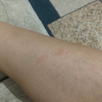 Dilek Elbir Beauty Center Lazer Epilasyon Deneyimim