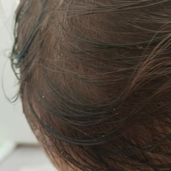 Dalin Bebek Şampuanı Kepek Yaptı