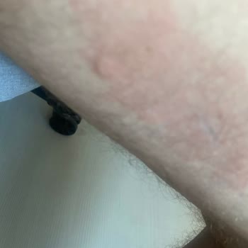 Vatan Bilgisayar'dan Alınan Rampage Marka Koltuğun Alerji Yapması