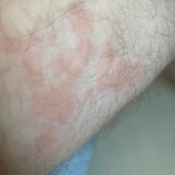 Vatan Bilgisayar'dan Alınan Rampage Marka Koltuğun Alerji Yapması