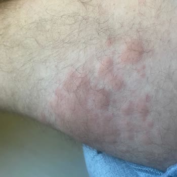 Vatan Bilgisayar'dan Alınan Rampage Marka Koltuğun Alerji Yapması