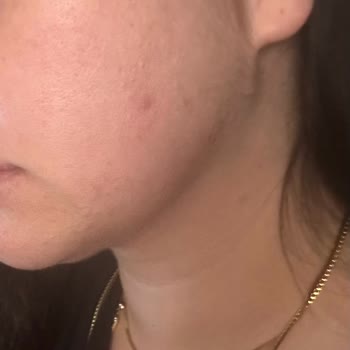 Kiperin Kolajen Sivilcelenme Ve Kilo Artışı