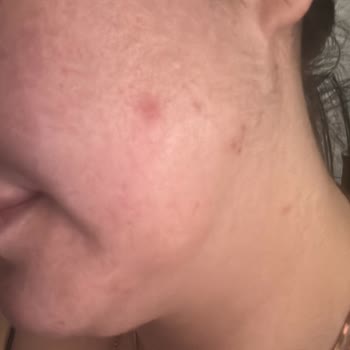 Kiperin Kolajen Sivilcelenme Ve Kilo Artışı