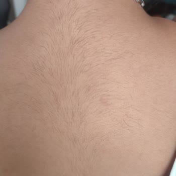 Aissha Beauty (Manavgat) Lazer Epilasyon Sonrası Artan Kıllar Ve Kötü Müşteri Hizmeti