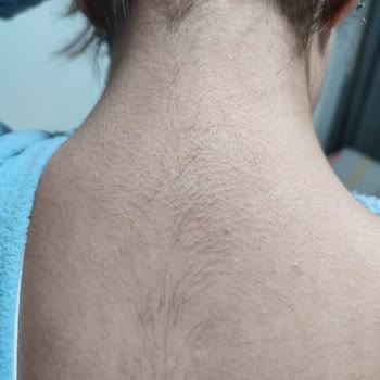 Aissha Beauty (Manavgat) Lazer Epilasyon Sonrası Artan Kıllar Ve Kötü Müşteri Hizmeti