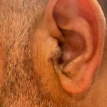 Eylül Öztürk Nail Spa Kulak Yanak Yanığı