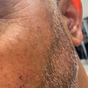 Eylül Öztürk Nail Spa Kulak Yanak Yanığı