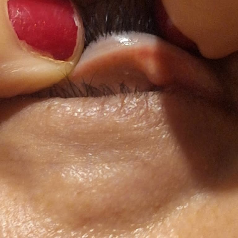 Özel Gözde Hastaneleri Göz Kapağı Şalazyon Operasyonu Başarısız