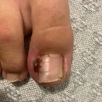 Liv Hospital Dermatoloji Tırnak Batması Operasyonu Pişmanlığı.