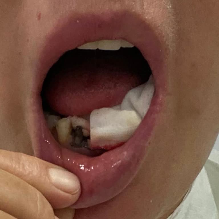 DT. Erman Ürer Çürüyen Porselen Kaplamalar