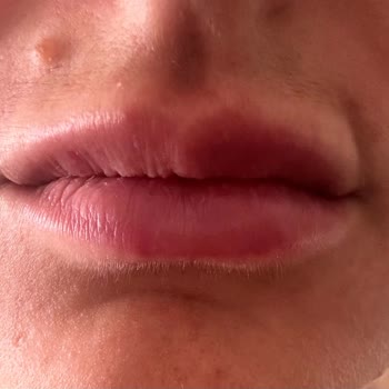 Esthe Novella Dudak Dolgusu İle Dudağımı Bozdular