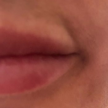 Esthe Novella Dudak Dolgusu İle Dudağımı Bozdular