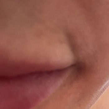 Esthe Novella Dudak Dolgusu İle Dudağımı Bozdular