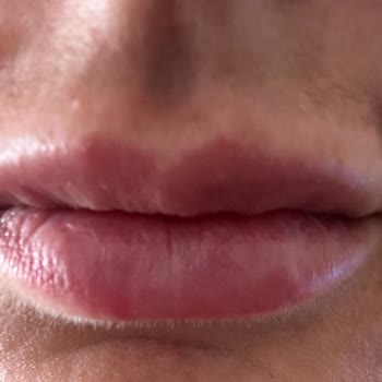 Esthe Novella Dudak Dolgusu İle Dudağımı Bozdular