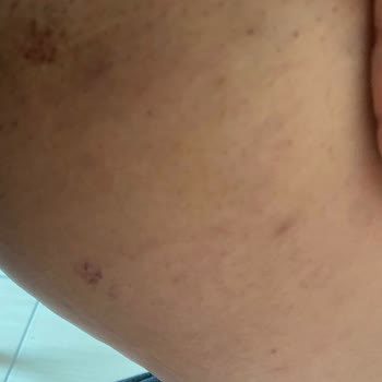 Aris Güzellik Merkezleri Güzellik Merkezinde Mobbing Ve Yanık Şikayeti