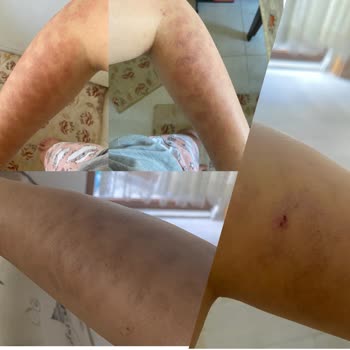 Denipol Hastanesi Lazer İşleminde Kolumu Yaktılar