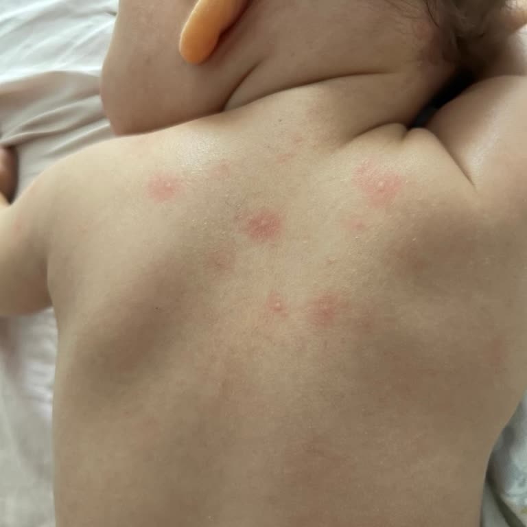 Mustela Atopik Cilt Şampuanı Çocuğumda Kırmızı Noktalar Yaptı
