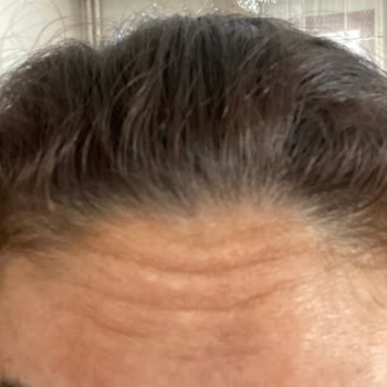 Estesante Clinic Estesante Bozuk Ürün Kullanımı