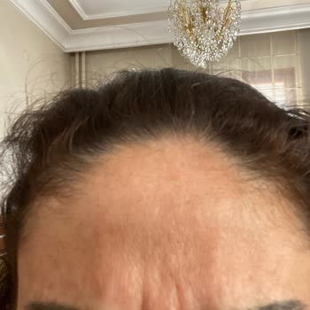 Estesante Clinic Estesante Bozuk Ürün Kullanımı