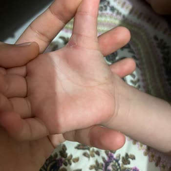 Özel Güney Hastanesi Yanlış Teşhis Ve Alerjik Reaksiyon