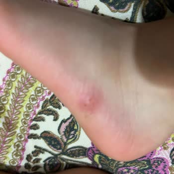 Özel Güney Hastanesi Yanlış Teşhis Ve Alerjik Reaksiyon