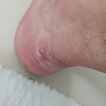 Skechers Zapatos Desgaste del Forro del Talón