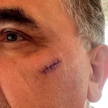 Renault Koleos 2018 - Fallo del Airbag en Accidente Grave