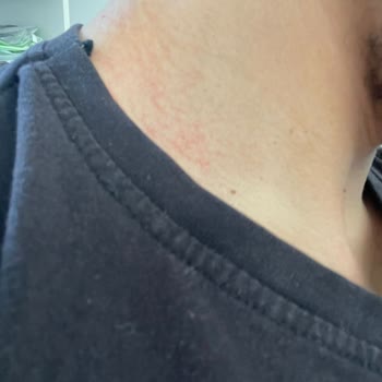 Bershka Collar Cambio de Color e Irritación en la Piel