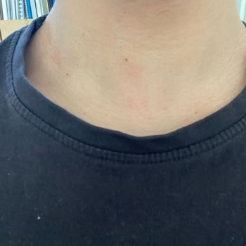 Bershka Collar Cambio de Color e Irritación en la Piel