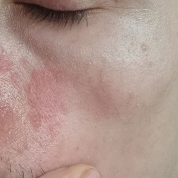 La Roche-Posay Kerium DS 40ml me causó enrojecimiento y ardor