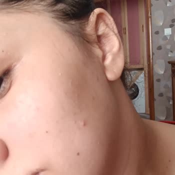 La Roche-Posay Protector Solar Me Causa Acné en la Cara