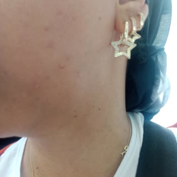 Yves Rocher Sérum Anti-Edad Me Causó Acné y Cicatrices