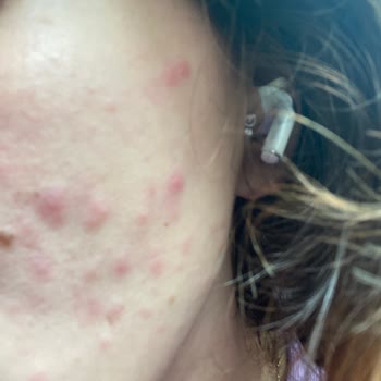 Yves Rocher Hidratante Me Causó Brotes en la Cara