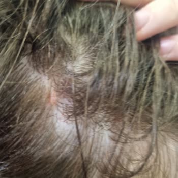 Yves Rocher Champú Anticaída causa caída del cabello