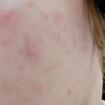 Mi cara se irritó con L'Oreal Paris Revitalift Clinical Protector Solar