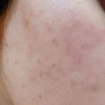 Mi cara se irritó con L'Oreal Paris Revitalift Clinical Protector Solar